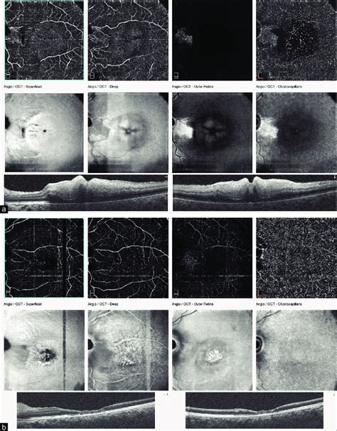 Image result for Optical Coherence Tomography Tutorial