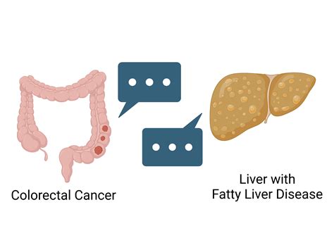 How Fatty Liver Disease Helps Cancer Thrive in the Liver - NCI