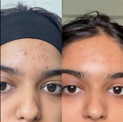 2% Salicylic Acid Anti-Acne Serum for Acne & Clogged Pores