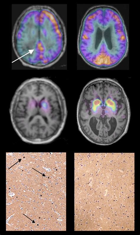 Image result for Dat Scan Lewy Body