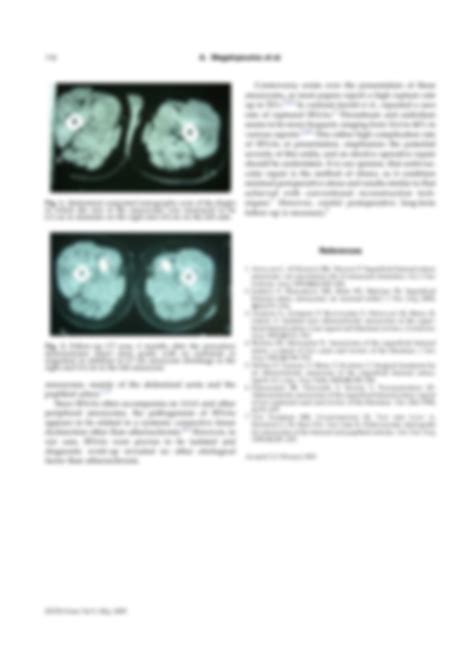 SOLUTION: Bilateral true isolated superficial femoral artery aneurysm report of a case and ...