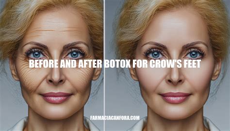 Before and After Botox for Crow's Feet: A Comprehensive Guide