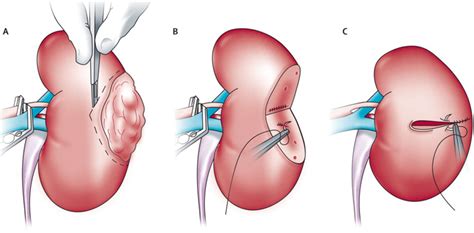 Image result for Open Nephrectomy Procedure