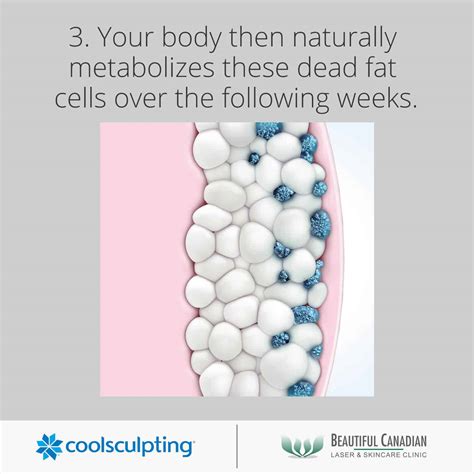CoolSculpting® Vancouver w/ Cost Info | Fat Freezing in Surrey | BC Laser