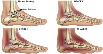 PT Guide to Ankle Sprain | Physical Therapy & Injury Specialists Physical Therapy & Injury ...