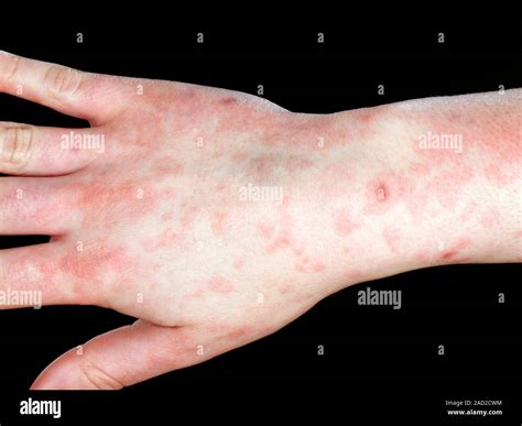 Epstein-Barr virus infection. Close-up of the hand of a 19-year-old female patient with a rash ...