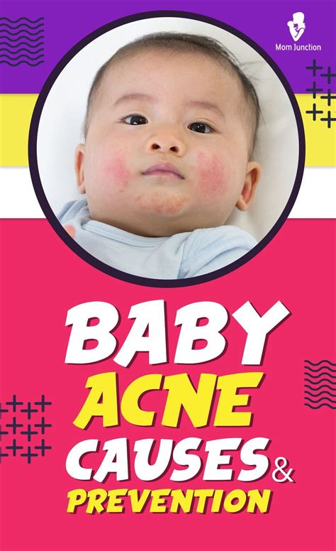 Baby acne causes symptoms and how to get rid of it – Artofit