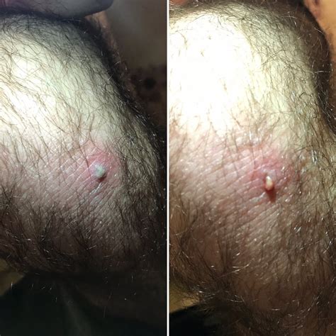 Before and after I lanced my SO’s infected knee pimple : r/popping