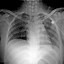 pulmonary edema 的图像结果