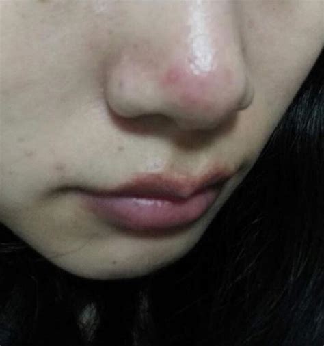 【图】为什么鼻子上老长痘痘呢？ 让我们一起来了解长痘的原因(2)_伊秀美容网|yxlady.com