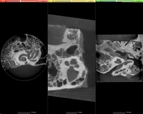 Image result for Modiolus Cochlea