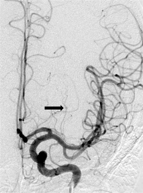Charcot-Bouchard Aneurysm Diagnosed with CTA and MRA | Journal of the ...