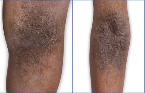 why doctor's struggle to identity eczema on darker tones Background