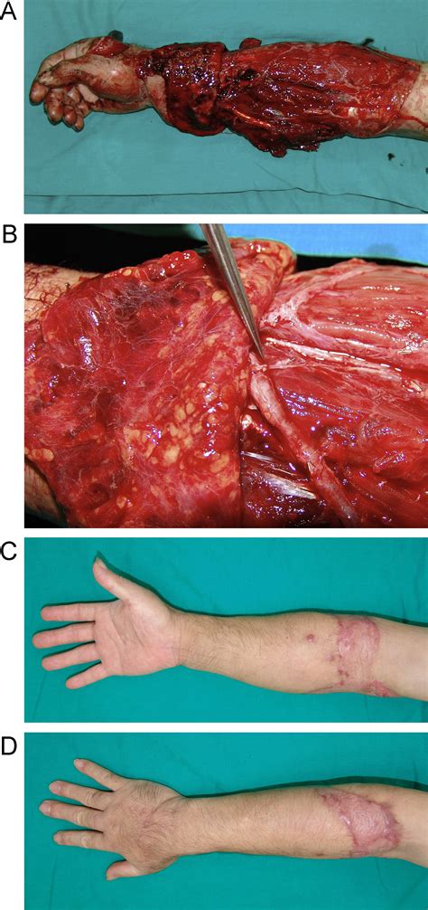 A new classification to aid the selection of revascularization techniques in major degloving ...