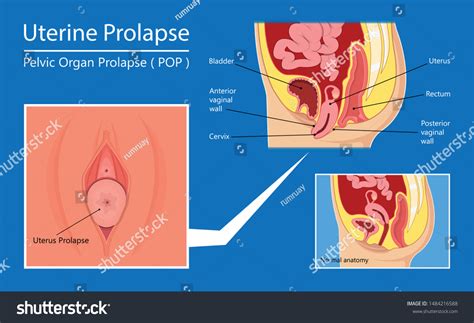 Pelvic Floor Prolapse Type Uterine Uterus Stock Vector (Royalty Free) 1484216588