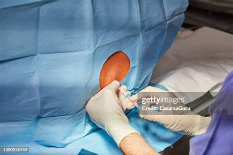 Image result for Epidural Injection Procedure