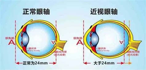2000度的近视，眼球要被“扯爆”！__中国医疗