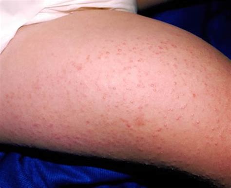 Keratosis Pilaris - Causes, Symptoms, How To Get Rid of It