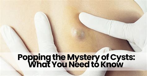 Image result for Back Full of Exploding Cysts