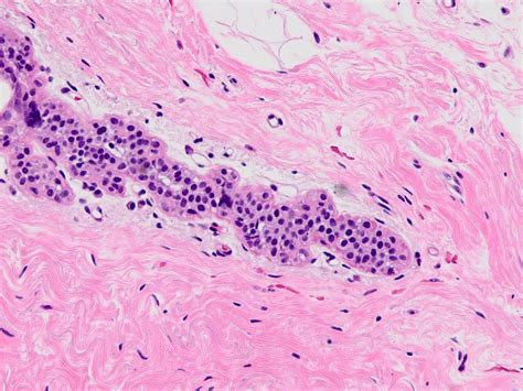 Pathology Outlines - Atypical lobular hyperplasia