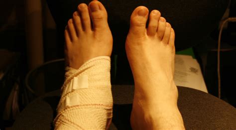 Allow Ankle Sprains to Heal