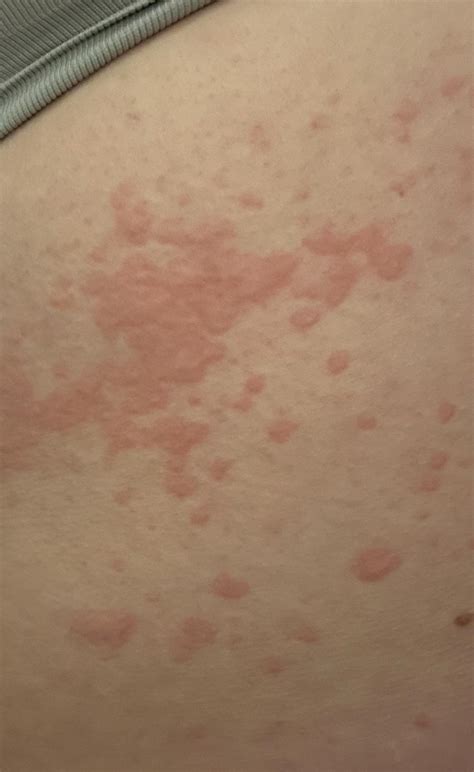 Rash Pictures SJS 的图像结果