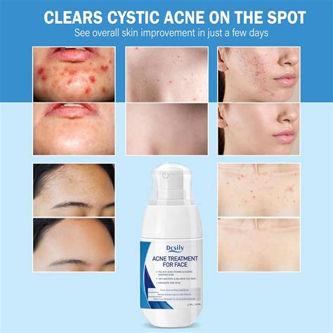IBaste Cystic & Hormonal Acne Serum with Salicylic Acid & India | Ubuy