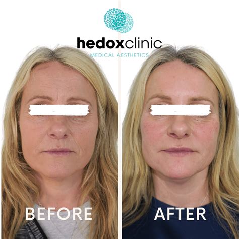 Nasolabial Folds Treatment London | Nasal Fold Filler - Hedox Clinic