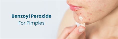 Benzoyl peroxide ee finanka: Hagaha