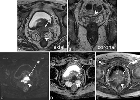 Stage 4 Prostate Cancer Mri at Christopher Cummings blog