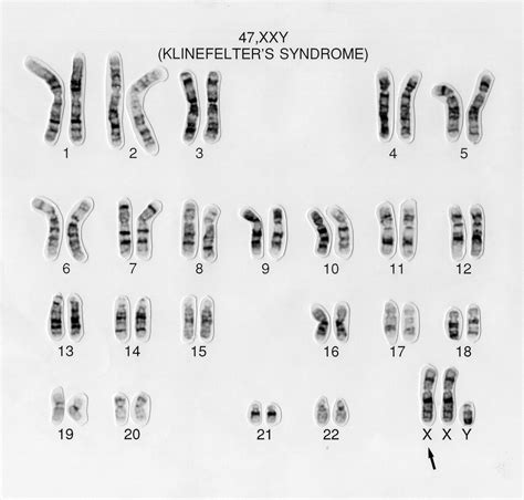 Klinefelter's syndrome karyotype 47,XXY | Wellcome Collection
