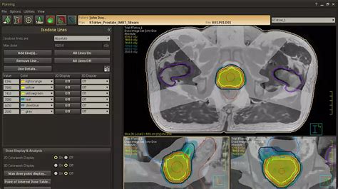 MRCAT Prostate and Auto-Contouring for MRI only RT