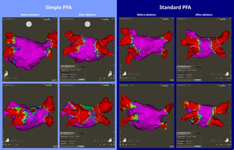 Pulsed field ablation for atrial fibrillation with a novel simplified ...