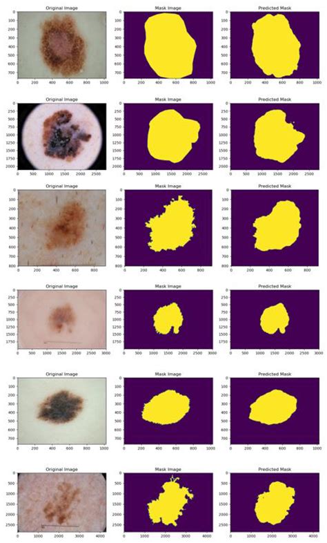 Anti-Aliasing Attention U-net Model for Skin Lesion Segmentation