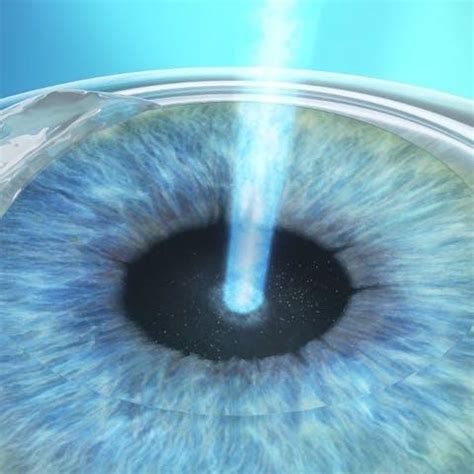 The PRK procedure in detail | ZEISS