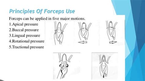 Image result for Simple Tooth Extraction Step