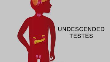 Pediatric Surgery : Undescended Testis : Undescended Testis Patient ...