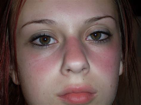 Anemic skin. Anemia Rash: Causes, Symptoms, and Effective Treatments Explained