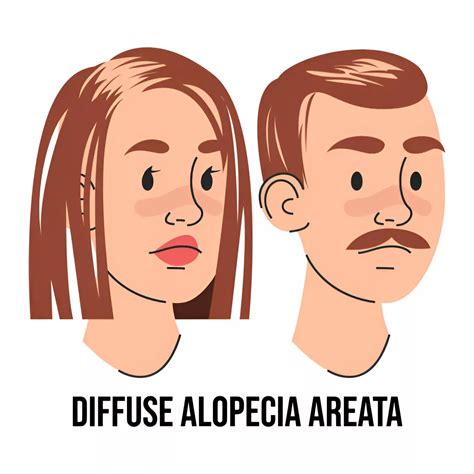 Image result for Diffuse Alopecia