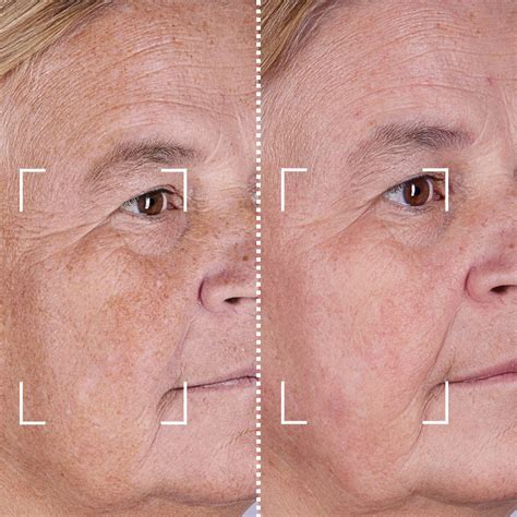 LED Mask Reviews 的图像结果