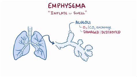 Image result for Emphysema Example