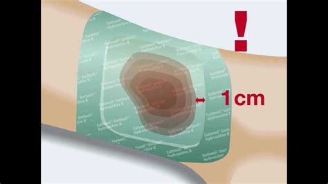 CUTIMED Cutimed Sorbact, ¡La ÚNICA INNOVACIÓN Con éxito, 42% OFF