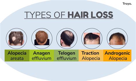 Hair Loss Types With Pictures at Esther Hunt blog