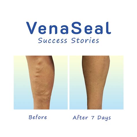 Varicose Glue Treatment | The Vein Center