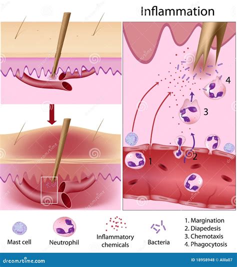 Inflammation Response Royalty Free Stock Photos - Image: 18958948
