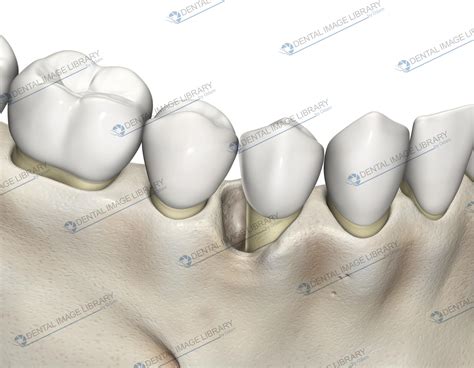 Image result for Two Walled Defect Perio