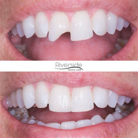 Dental Bonding Chipped Tooth