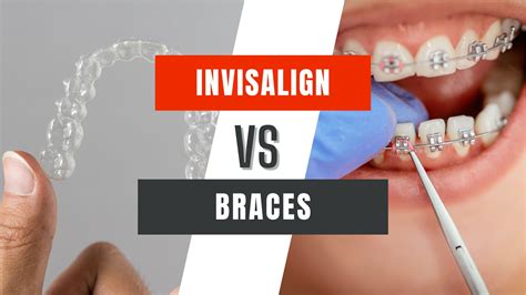 The Ultimate Battle of Invisalign vs Braces