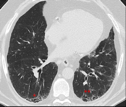 Dermatologische Manifestationen von interstitiellen Lungenerkrankungen ...