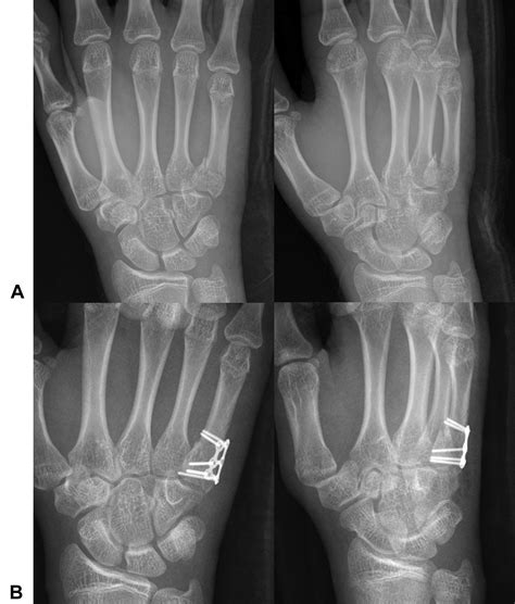 Surgical Outcomes of Percutaneous Pinning and Open Locking Plating in ...